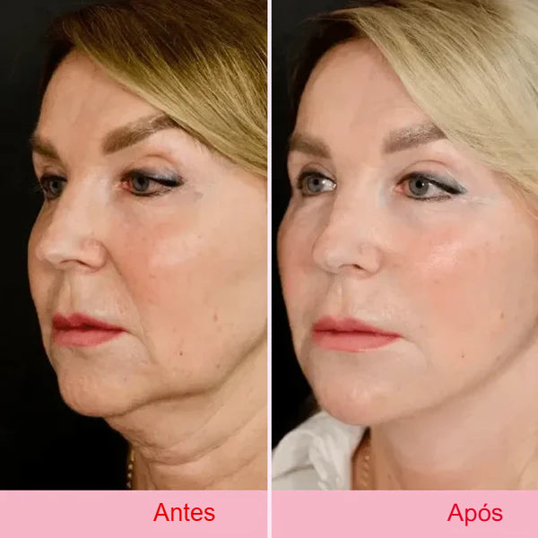 Fita Lifting Facial Adesiva para V-Face Anti Rugas