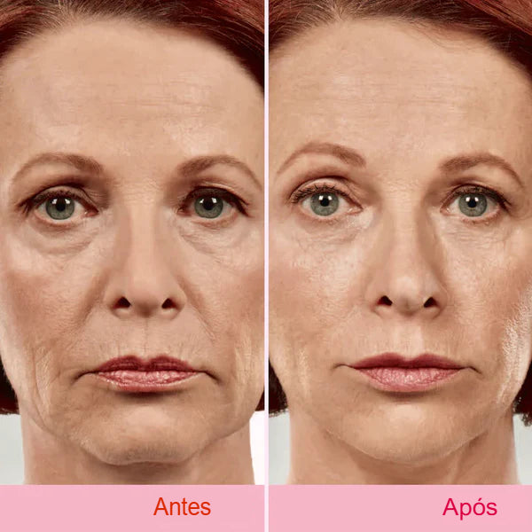 Fita Lifting Facial Adesiva para V-Face Anti Rugas
