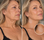 BeutyLift - Adesivo para rugas no pescoço