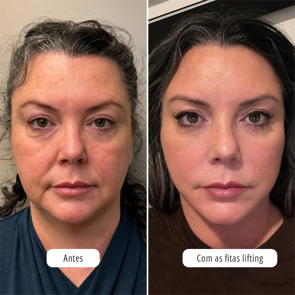 Fita Lifting Facial Adesiva — Efeito V-Face Imediato