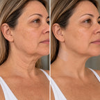 BeutyLift - Adesivo para rugas no pescoço
