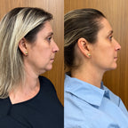 V-Lift - Máscara de Contorno Facial - Suaviza Rugas, Papada e Modela o Rosto